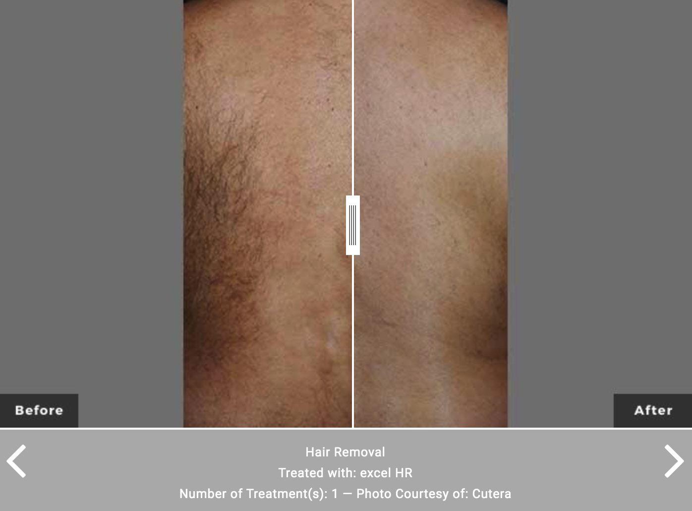 XEO Cutera Laser Hair Removal - Before and After - Rancho Cucamonga, CA Shylee Skin & Wellness