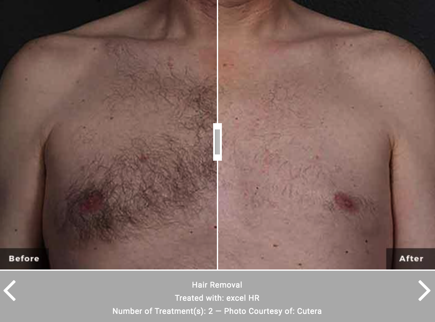 XEO Cutera Laser Hair Removal - Before and After - Rancho Cucamonga, CA Shylee Skin & Wellness